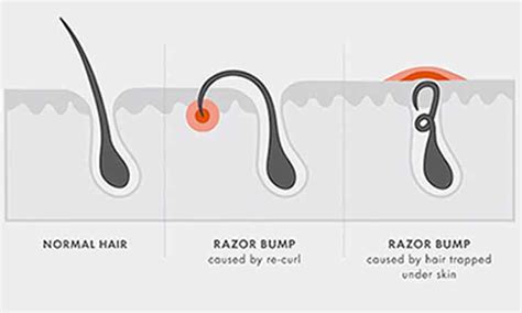 6 Home Remedies To Get Rid Of Razor Bumps Fast 2022