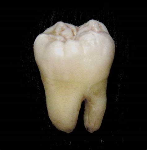 Molar Tooth Wikidoc