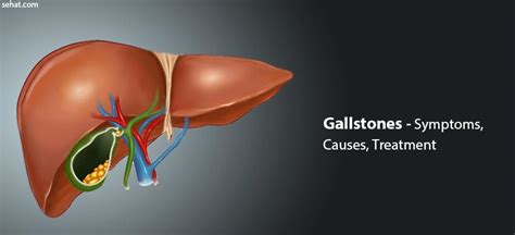 Gallstones Risk Factors Causes Symptoms Treatment Prevention