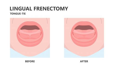 Before During And After What To Expect From Tongue Tie Treatment