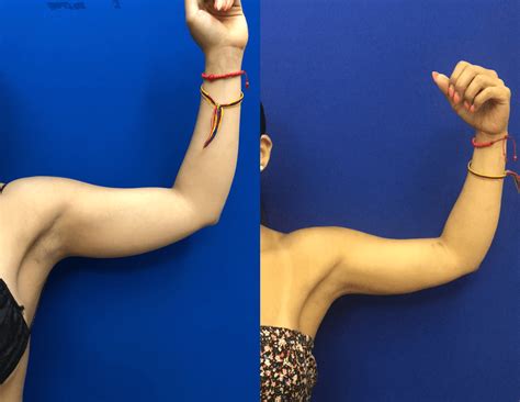 Before & After: Arms Liposuction | Neinstein Plastic Surgery