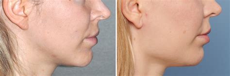 Plastic Surgery Case Study Female Jaw Angle Implants For A More