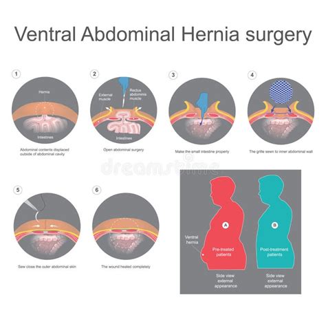 Ventral Hernia Is A Bulge Of Tissues Through An Opening Of Weakness
