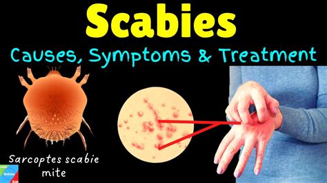 Scabies Causes Symptoms Diagnosis Treatment Prevention Youtube