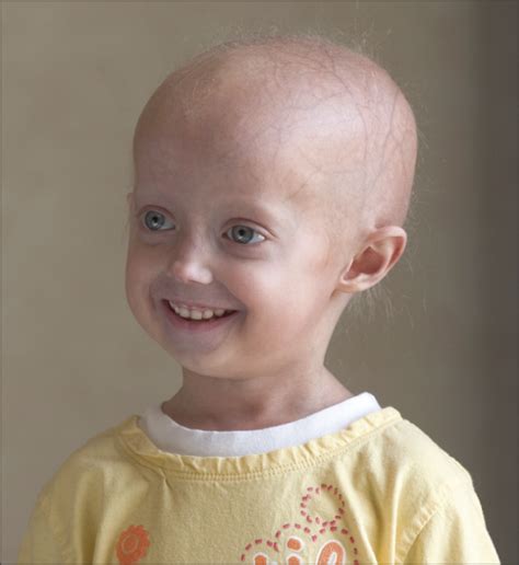 Gene Discovery Speeds Progeria Research Genetics And Genomics Jama Jama Network