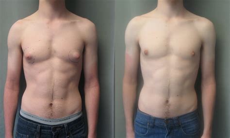 How To Get Rid Of Man Boobs Male Gynecomastia Fit Clarity