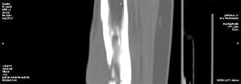 Chronic Osteomyelitis Of Tibia Ct Image