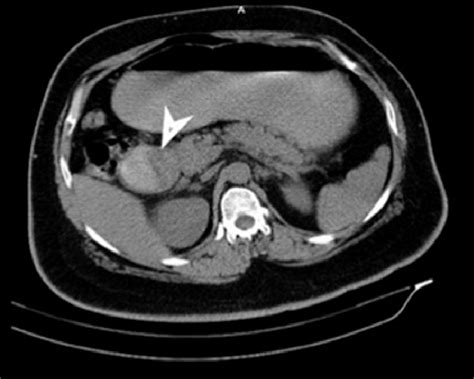 Ct Transverse Image Showing First And Second Part Of Duodenum Filled