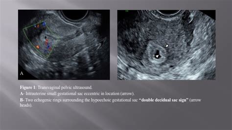 Transvaginal Pelvic Ultrasound A Intrauterine Small Gestational Sac