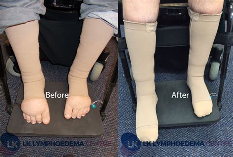 Complete Decongestive Therapy And Compression Therapy Lk Lymphoedema
