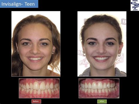 Invisalign For Gaps Before And After Before And After