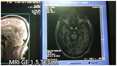 Mri Brain Protocolsequences Ge 15 Tesla Youtube