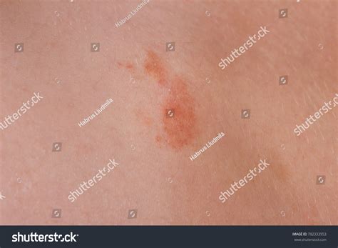Great Red Spot On Skin Closeup Stock Photo 782333953 Shutterstock