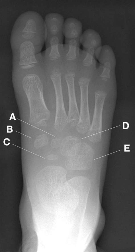 Radiograph Of A 3 Year Old Childs Right Foot The Bmj