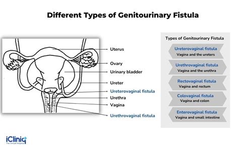Urethrovaginal Fistula