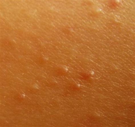 Keratosis Pilaris Pictures Treatment Symptoms And Causes Hubpages