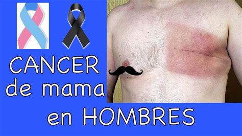 cáncer de mama en hombres youtube