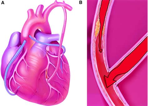 Angioplasty Versus Bypass Surgery For Coronary Artery Disease Circulation