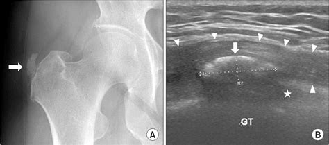 Figure From Calcific Tendinopathy Of The Gluteus Medius Mimicking