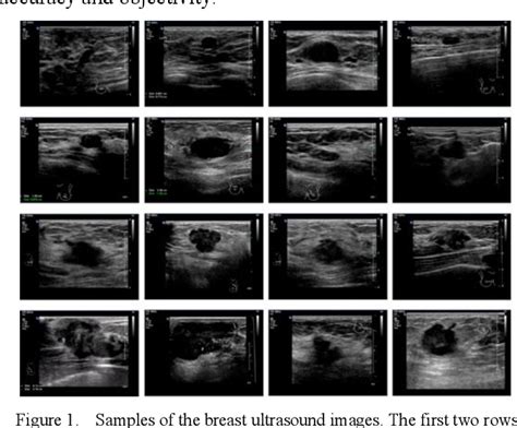Multi Feature Fusion For Ultrasound Breast Image Classification Of