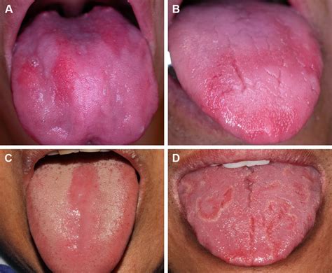 Vitamin B Deficiency Tongue