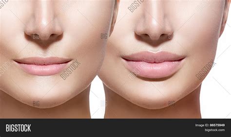Before After Lip Image And Photo Free Trial Bigstock