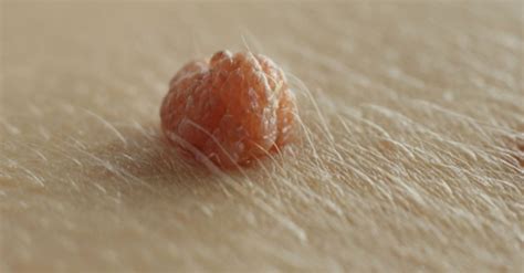 7 fantastic home remedies to get rid of skin tags sdarc wellness center chiropractic care