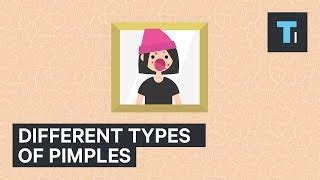 Different Types Of Pimples And How To Treat Them Doovi