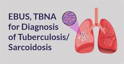 Ebus Tbna For Diagnosis Of Tuberculosis Sarcoidosis
