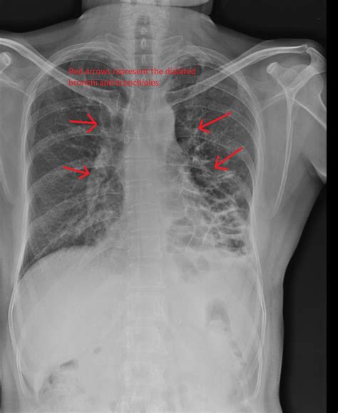 Bronchiectasis Chest X Ray Wikidoc