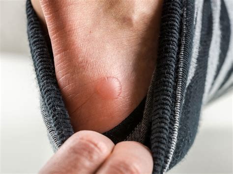 Diabetic Blisters Bullosis Diabeticorum Renew Physical Therapy