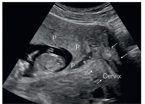 The Detailed First Trimester Ultrasound Examination Radiology Key