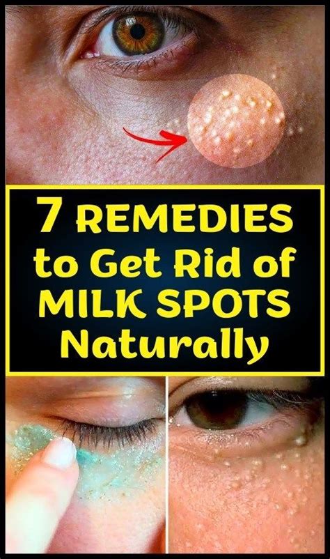 7 Remedies To Get Rid Of Milk Spots Naturally Healthy Tips Skin