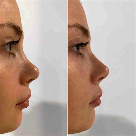 Nose Fillers Example 3 Dr Aaron Stanes Anti Ageing And Cosmetic