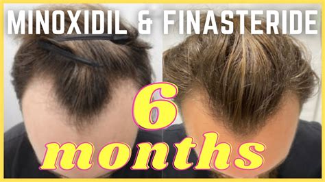 Minoxidil And Finasteride 6 Month Update Christopher Painter Youtube