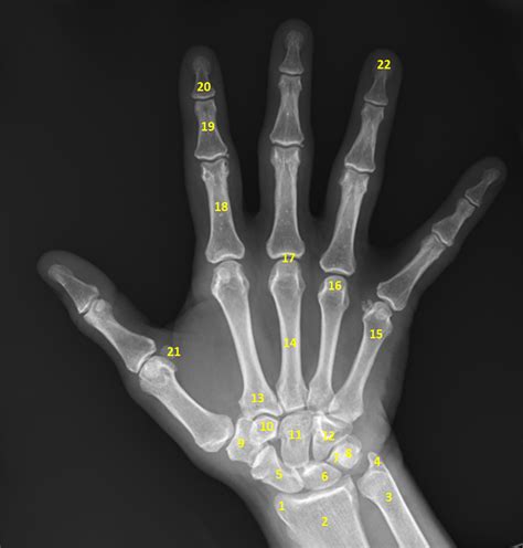 Normal Hand X Ray Colorvir X Ray Photo Of Normal Right Hand Stock