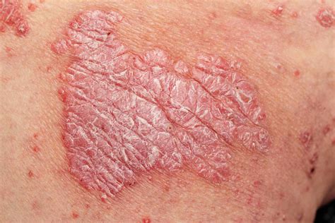 Is Psoriasis Contagious Stigma Facts Reassurance