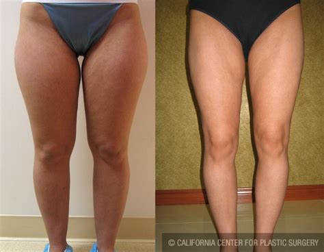 Jelqing is a largely considered a girth exercise, but will help with length exercise until you gain your first inch. Patient #6682 Liposuction Thighs Before and After Photos ...