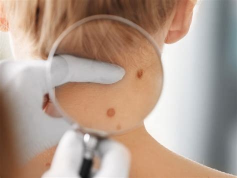 Lumps And Bumps On Skin Explained Best Health Canada