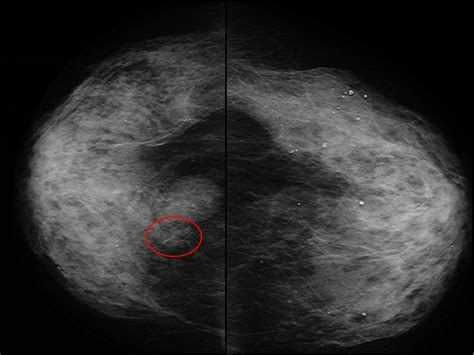 Figure 20 From Imaging Spectrum Of Breast Focal Fibrocystic Changes