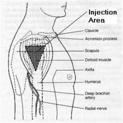Deltoid Intramuscular Injection Hubpages