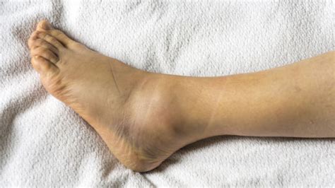 Overview Of A Sprained Ankle Foot Houston