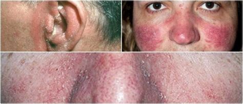 Treating Seborrheic Dermatitis On Face Causes Symptoms Treatment My Xxx Hot Girl