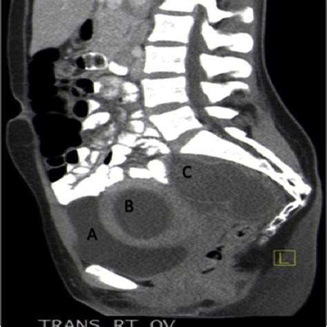 The Sagittal Plane Of Ct Scan With Oral Contrast A Bladder B