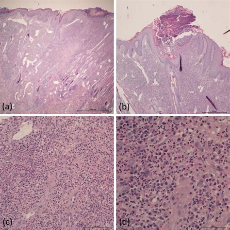 Feline Familial Pedal Eosinophilic Dermatosis In Two Littermates