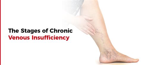 The Stages Of Chronic Venous Insufficiency