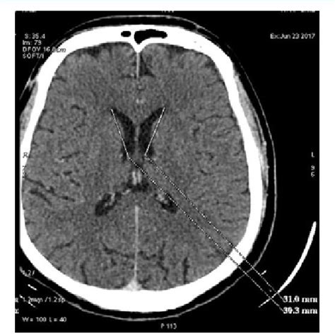 Ct Axial Image Of The Brain Showing The Length Of The Left Lateral
