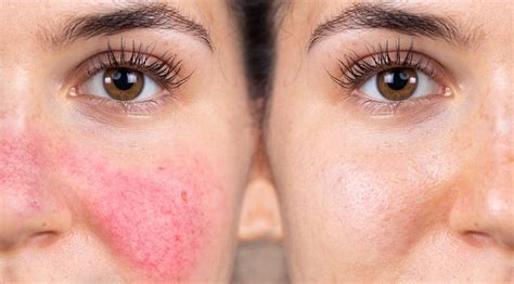 How To Manage Rosacea Simply Clinics