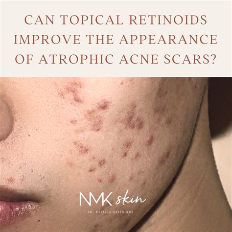 Can Topical Retinoids Improve The Appearance Of Atrophic Acne Scars