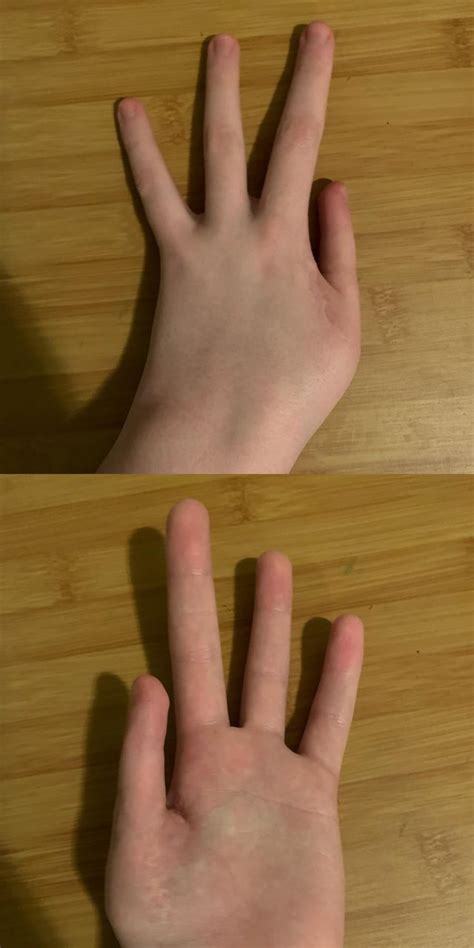 My Left Hand Is Missing A Finger As It Was What Formed My Thumb R